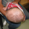 Plagiocephaly